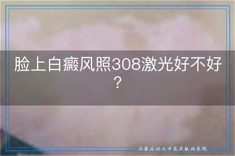 脸上白癜风照308激光好不好？