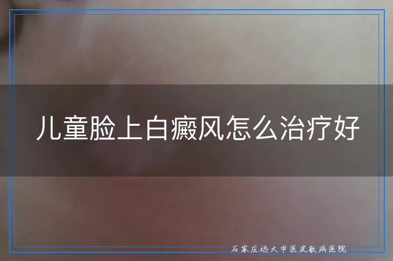儿童脸上白癜风怎么治疗好
