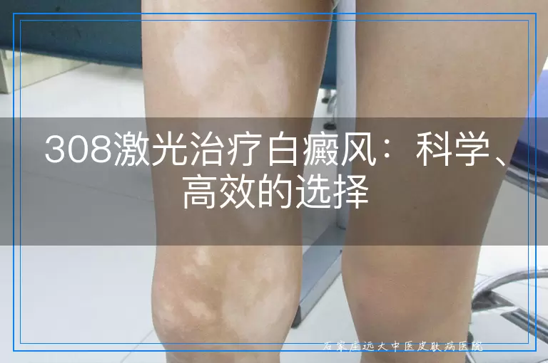 308激光治疗白癜风：科学、高效的选择