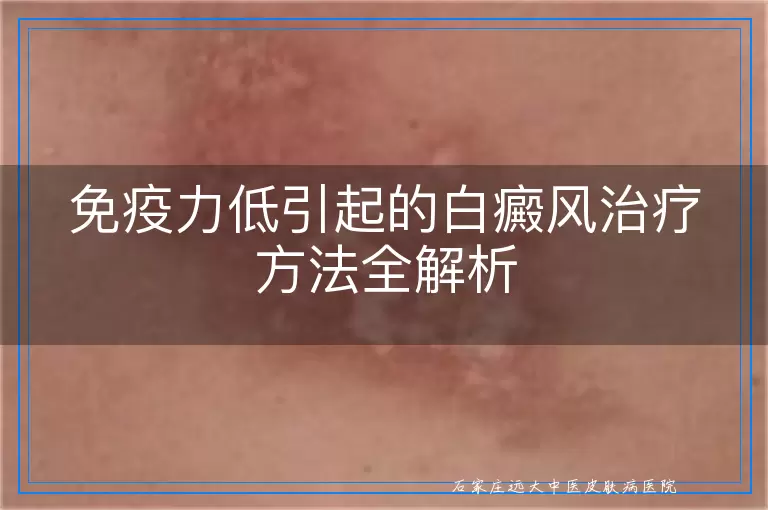 免疫力低引起的白癜风治疗方法全解析