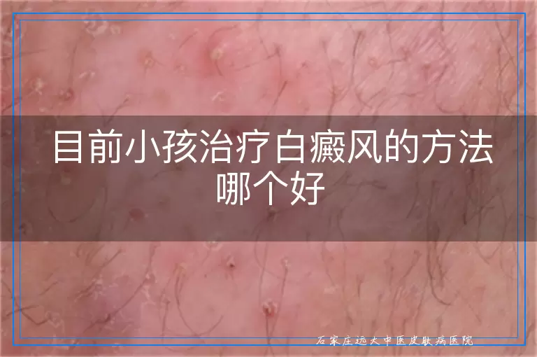 目前小孩治疗白癜风的方法哪个好