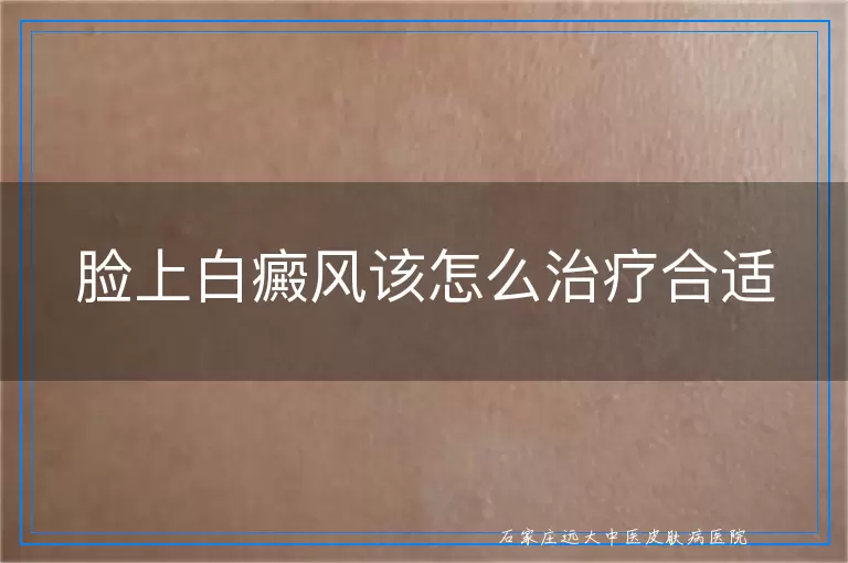 脸上白癜风该怎么治疗合适