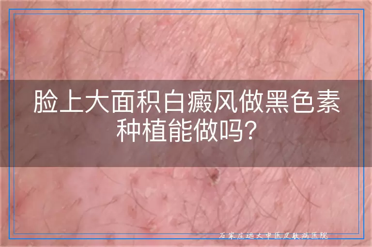 脸上大面积白癜风做黑色素种植能做吗？