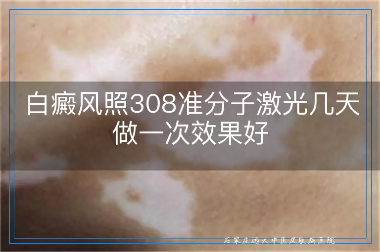 白癜风照308准分子激光几天做一次效果好