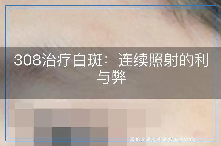308治疗白斑：连续照射的利与弊