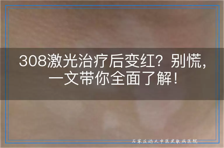308激光治疗后变红？别慌，一文带你全面了解！