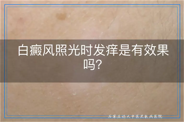 白癜风照光时发痒是有效果吗？