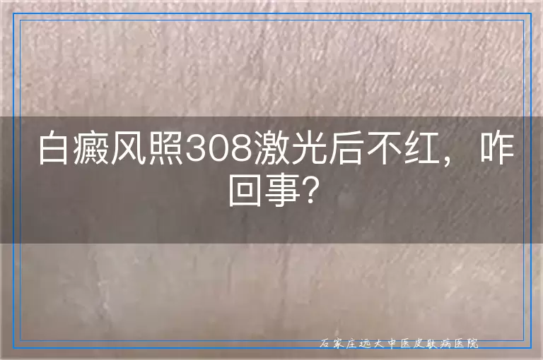 白癜风照308激光后不红，咋回事？