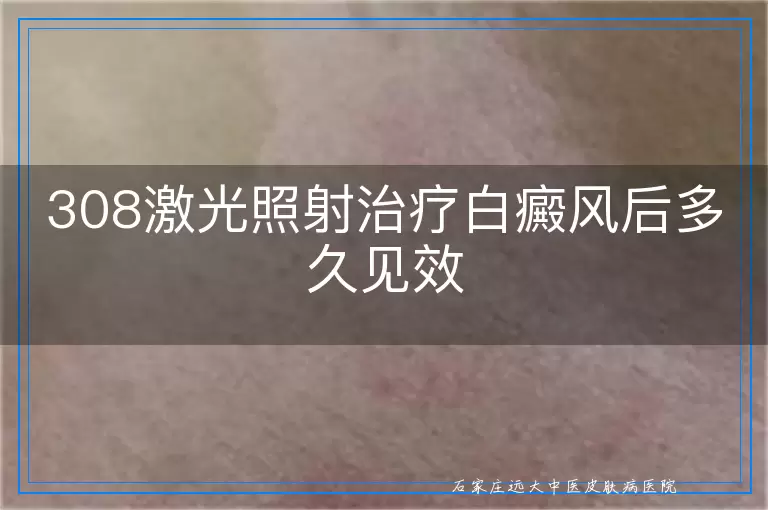 308激光照射治疗白癜风后多久见效