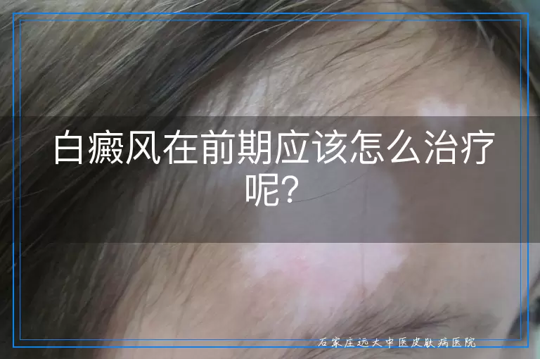 白癜风在前期应该怎么治疗呢？