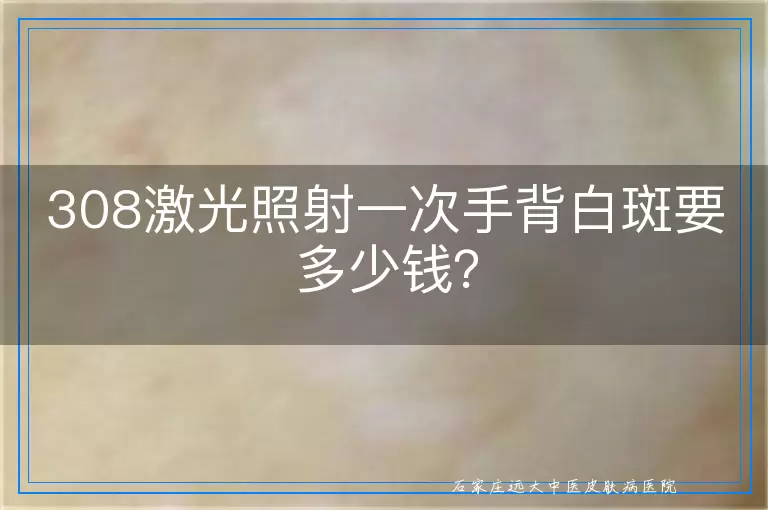 308激光照射一次手背白斑要多少钱？