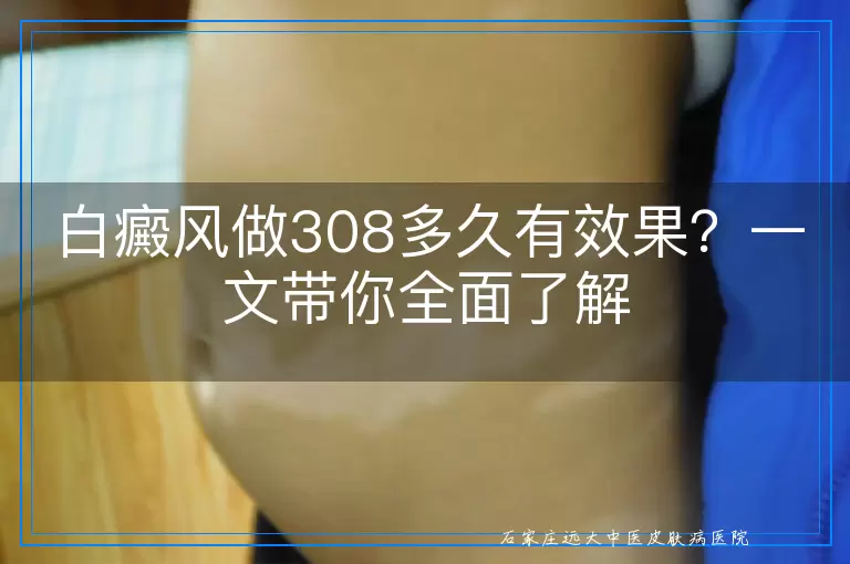 白癜风做308多久有效果？一文带你全面了解