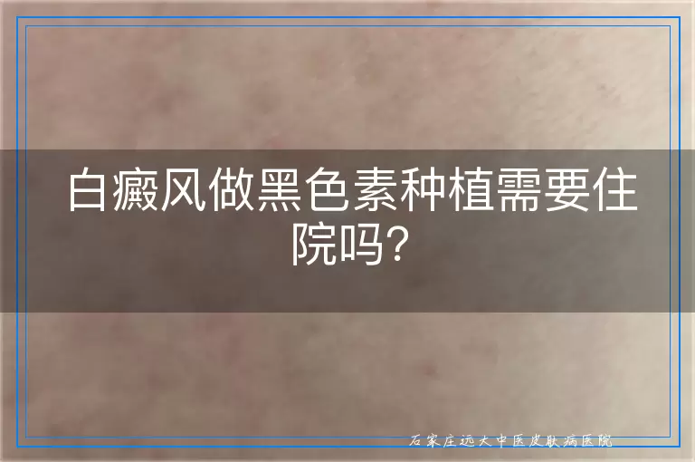 白癜风做黑色素种植需要住院吗？