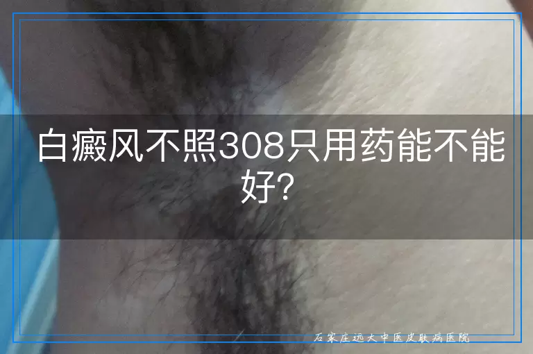 白癜风不照308只用药能不能好？