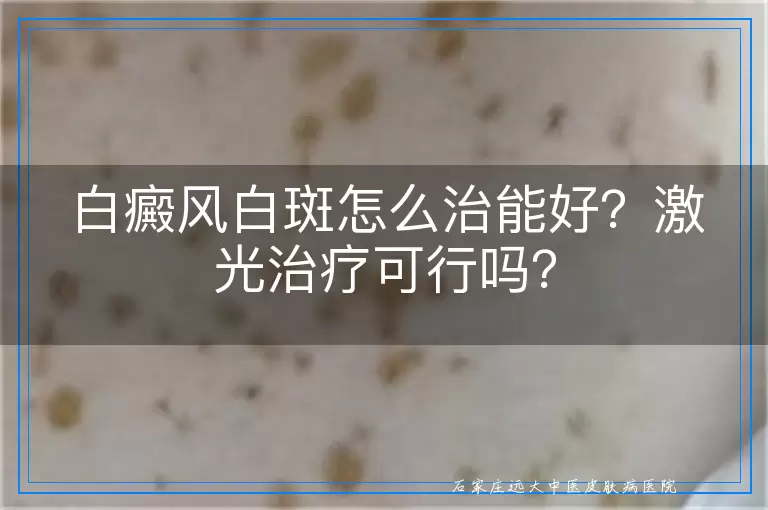 白癜风白斑怎么治能好？激光治疗可行吗？
