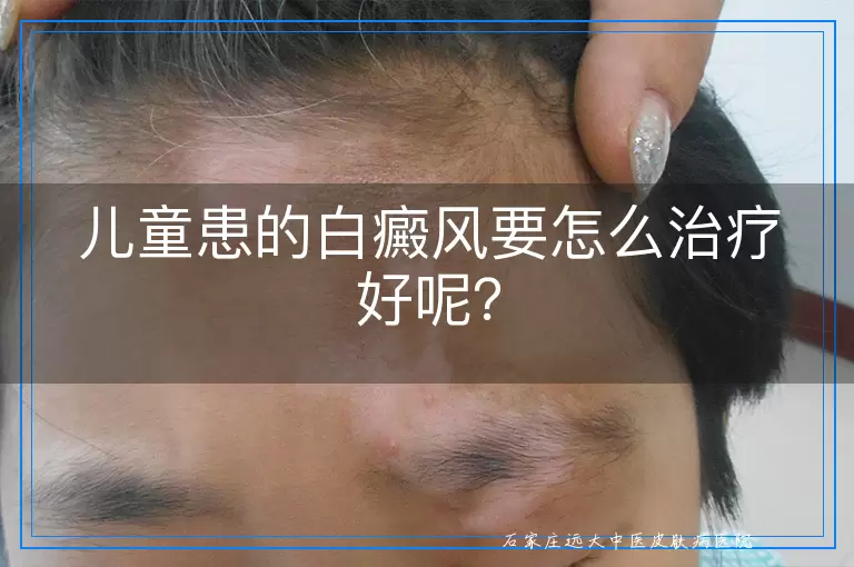 儿童患的白癜风要怎么治疗好呢？