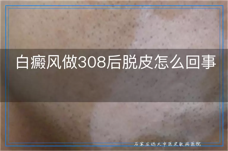 白癜风做308后脱皮怎么回事