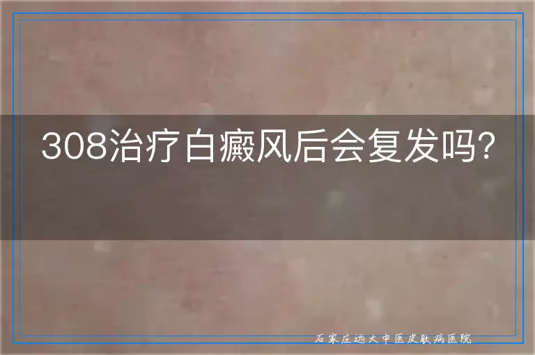 308治疗白癜风后会复发吗？