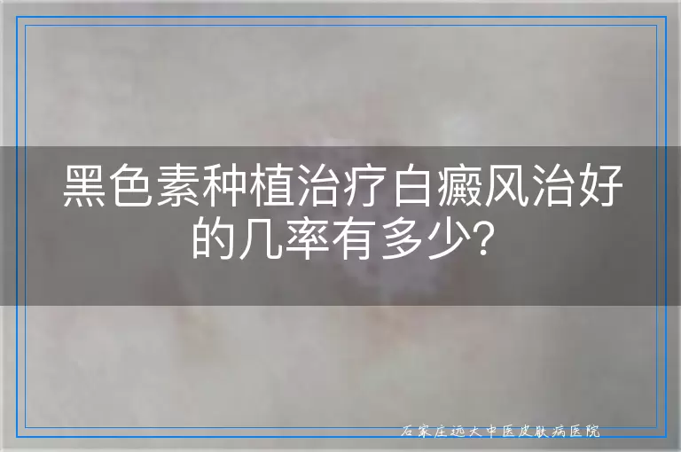 黑色素种植治疗白癜风治好的几率有多少？