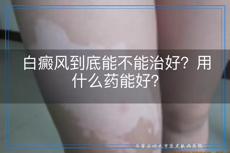 白癜风到底能不能治好？用什么药能好？