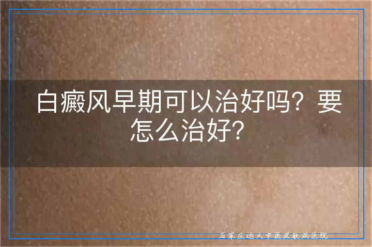白癜风早期可以治好吗？要怎么治好？