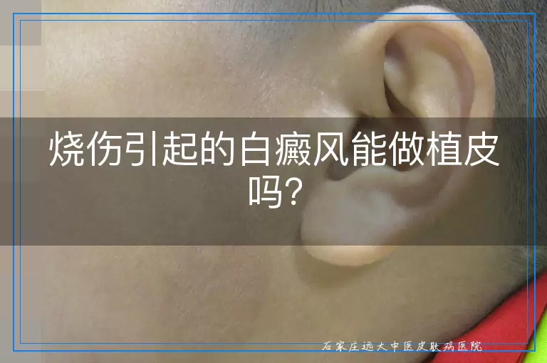 烧伤引起的白癜风能做植皮吗？