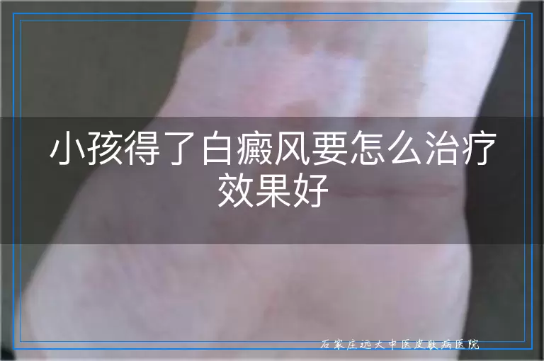 小孩得了白癜风要怎么治疗效果好
