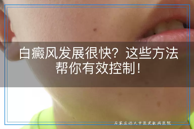 白癜风发展很快？这些方法帮你有效控制！