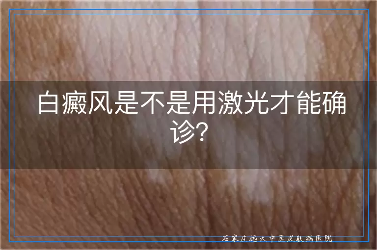 白癜风是不是用激光才能确诊？