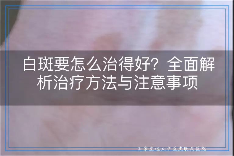 白斑要怎么治得好？全面解析治疗方法与注意事项