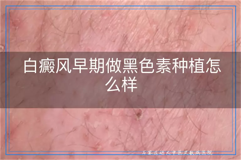 白癜风早期做黑色素种植怎么样