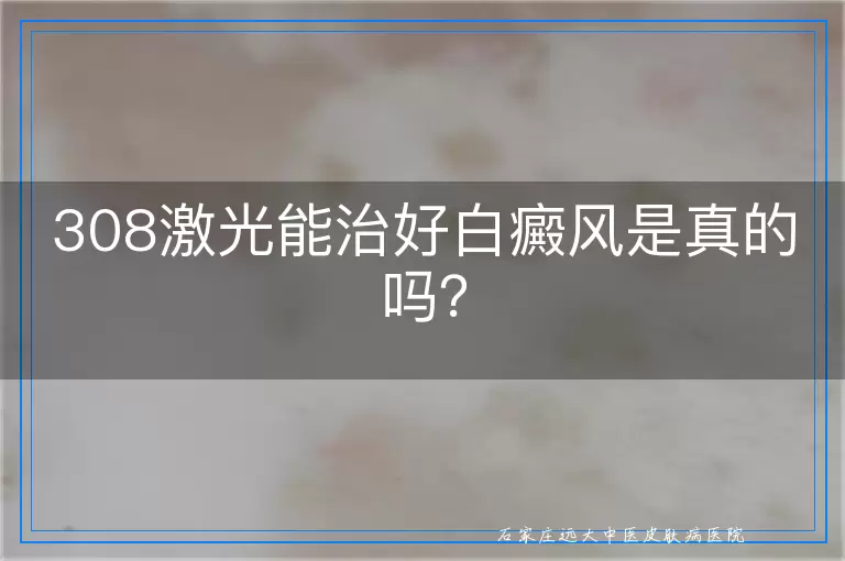 308激光能治好白癜风是真的吗？