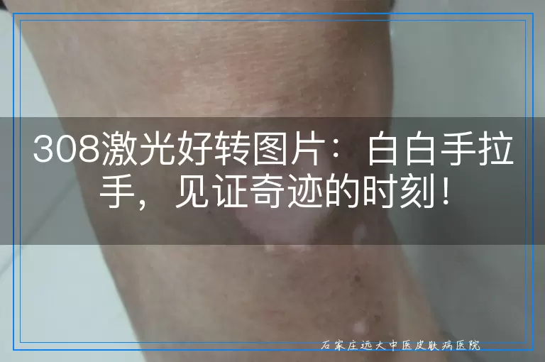 308激光好转图片：白白手拉手，见证奇迹的时刻！