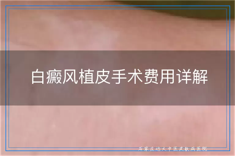 白癜风植皮手术费用详解