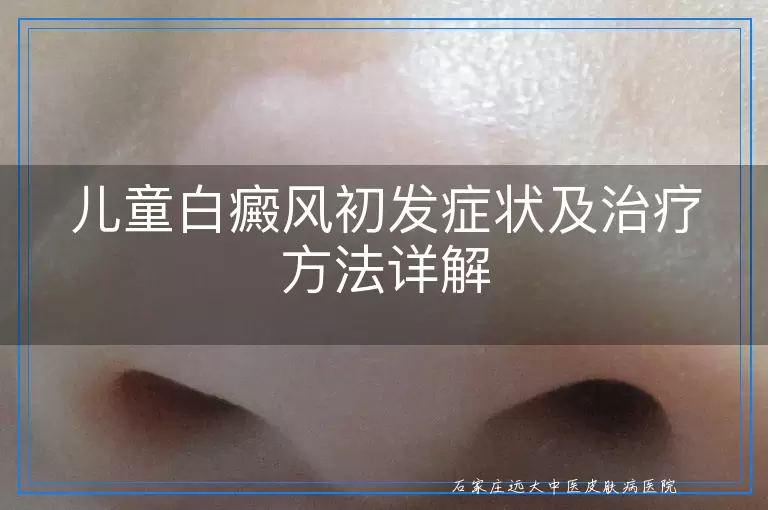 儿童白癜风初发症状及治疗方法详解
