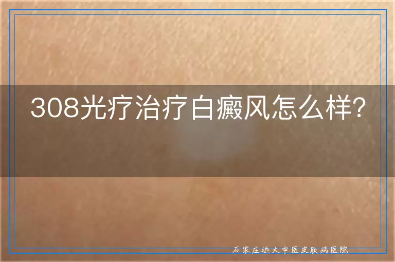 308光疗治疗白癜风怎么样？