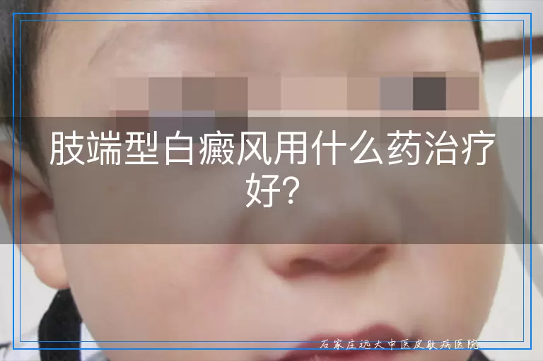 肢端型白癜风用什么药治疗好？