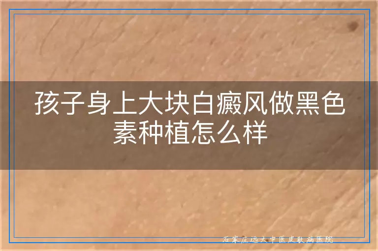 孩子身上大块白癜风做黑色素种植怎么样