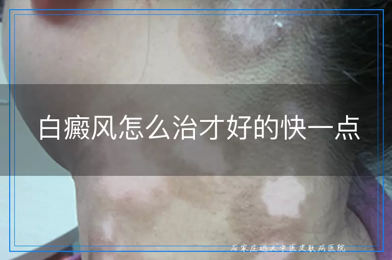 白癜风怎么治才好的快一点