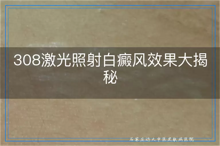 308激光照射白癜风效果大揭秘