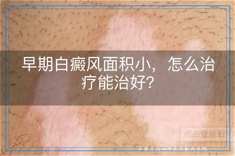 早期白癜风面积小，怎么治疗能治好？
