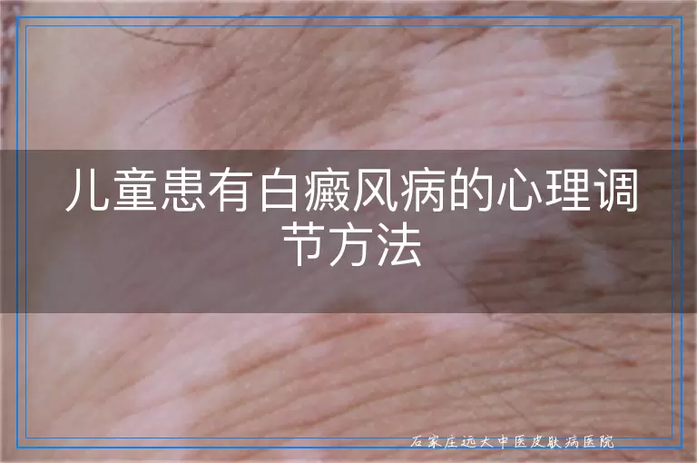 儿童患有白癜风病的心理调节方法