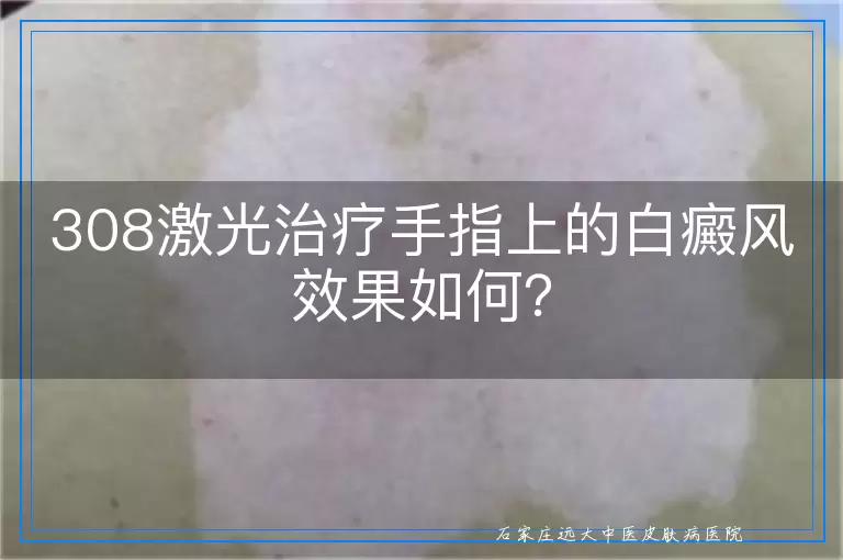 308激光治疗手指上的白癜风效果如何？