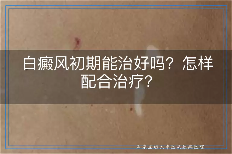 白癜风初期能治好吗？怎样配合治疗？