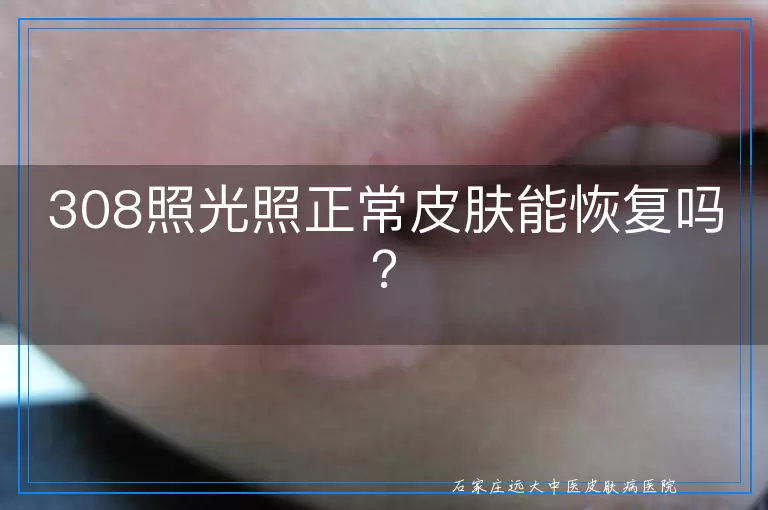 308照光照正常皮肤能恢复吗？