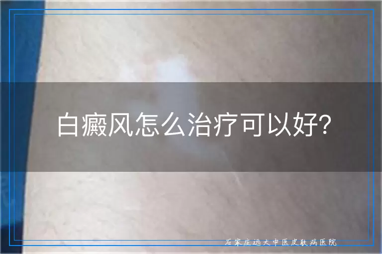 白癜风怎么治疗可以好？