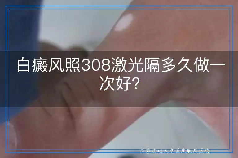 白癜风照308激光隔多久做一次好？