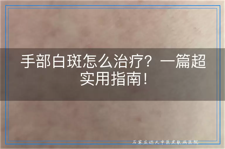 手部白斑怎么治疗？一篇超实用指南！