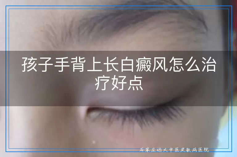 孩子手背上长白癜风怎么治疗好点