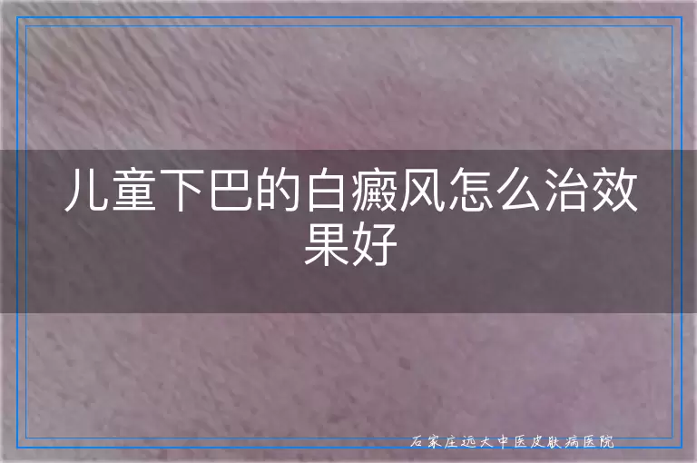 儿童下巴的白癜风怎么治效果好